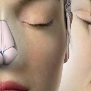 Is Rhinoplasty the Right Choice for Me? hq720