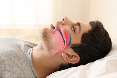 Sleep apnea causing loud snoring and breathing problems