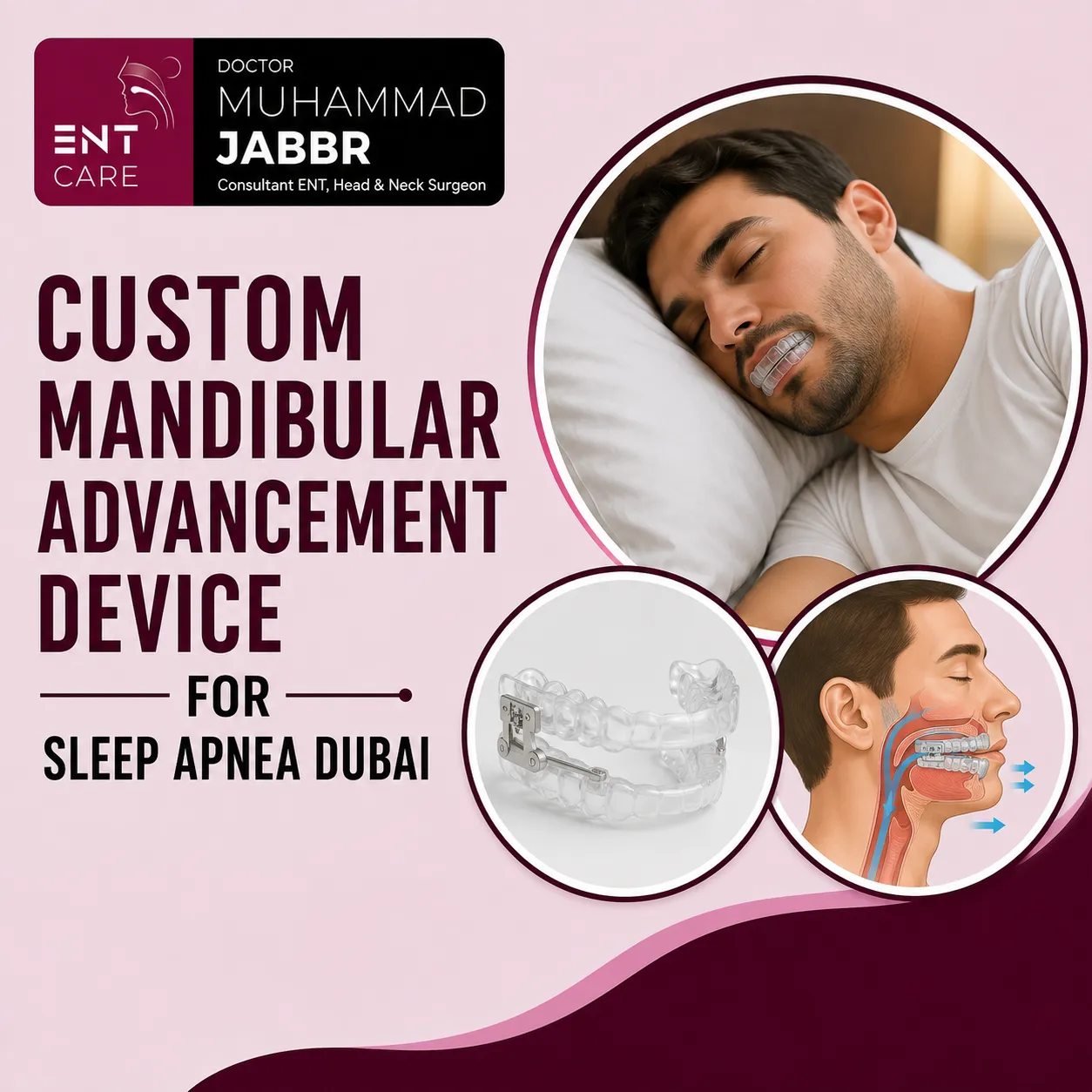 Custom Mandibular Advancement Device for Sleep Apnea Dubai