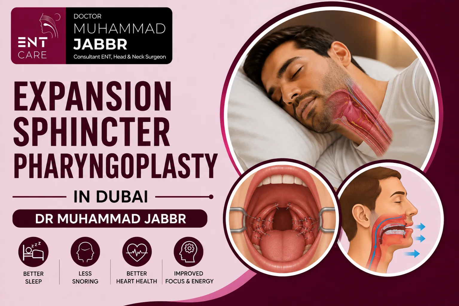 Expansion Sphincter Pharyngoplasty in Dubai by Dr Muhammad Jabbr