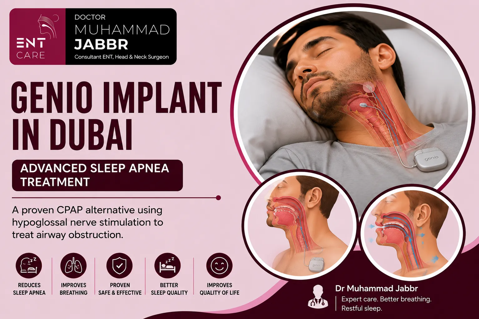 Genio Implant in Dubai by Dr Muhammad Jabbr