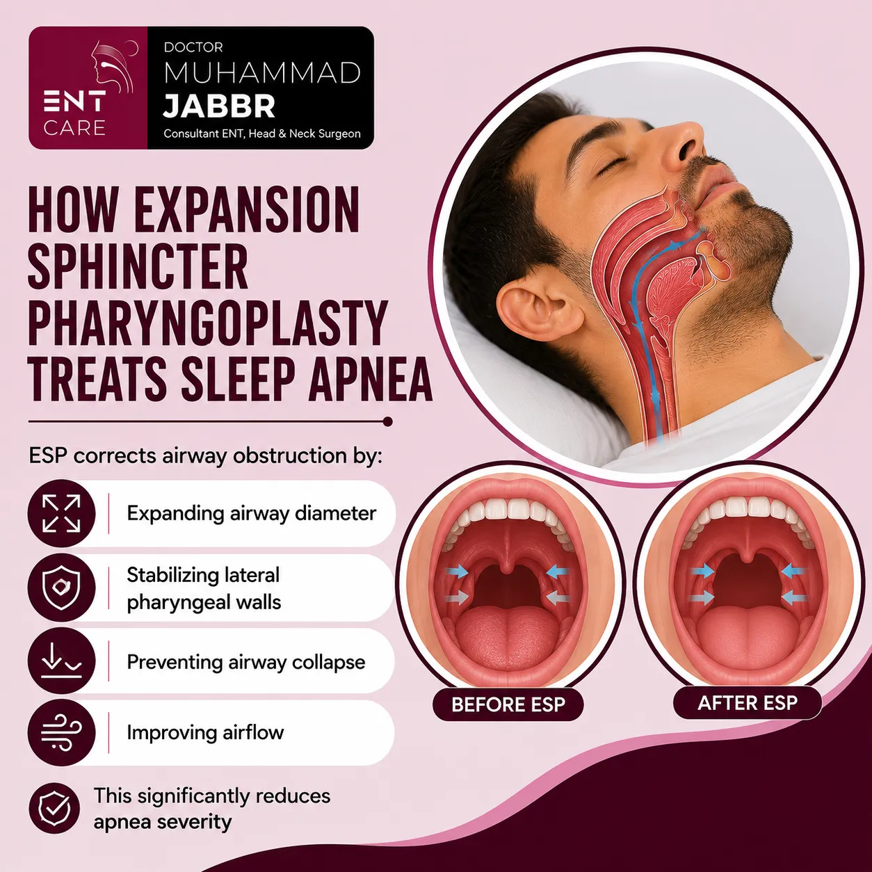 How Expansion Sphincter Pharyngoplasty Treats Sleep Apnea
