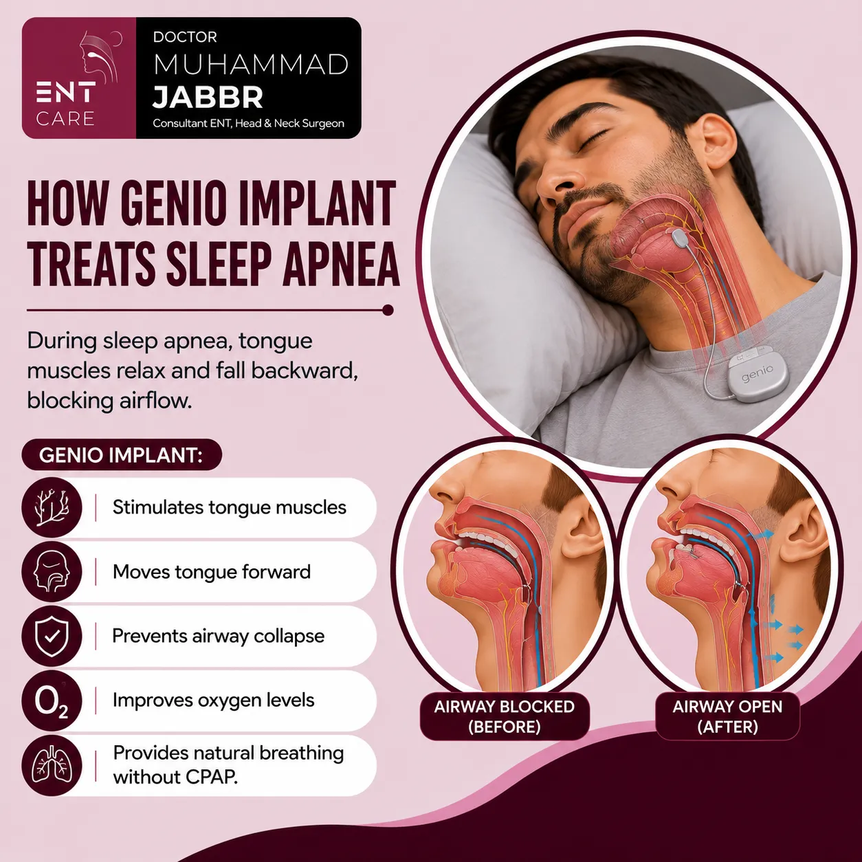 How Genio Implant Treats Sleep Apnea