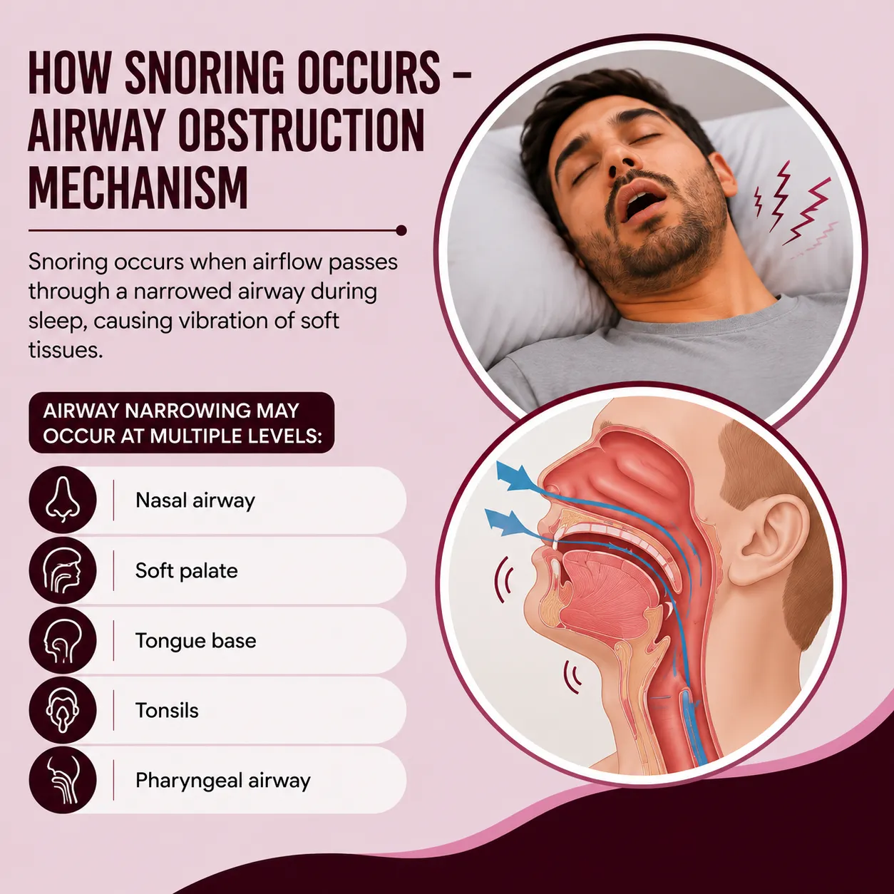 How Snoring Occurs – Airway Obstruction Mechanism