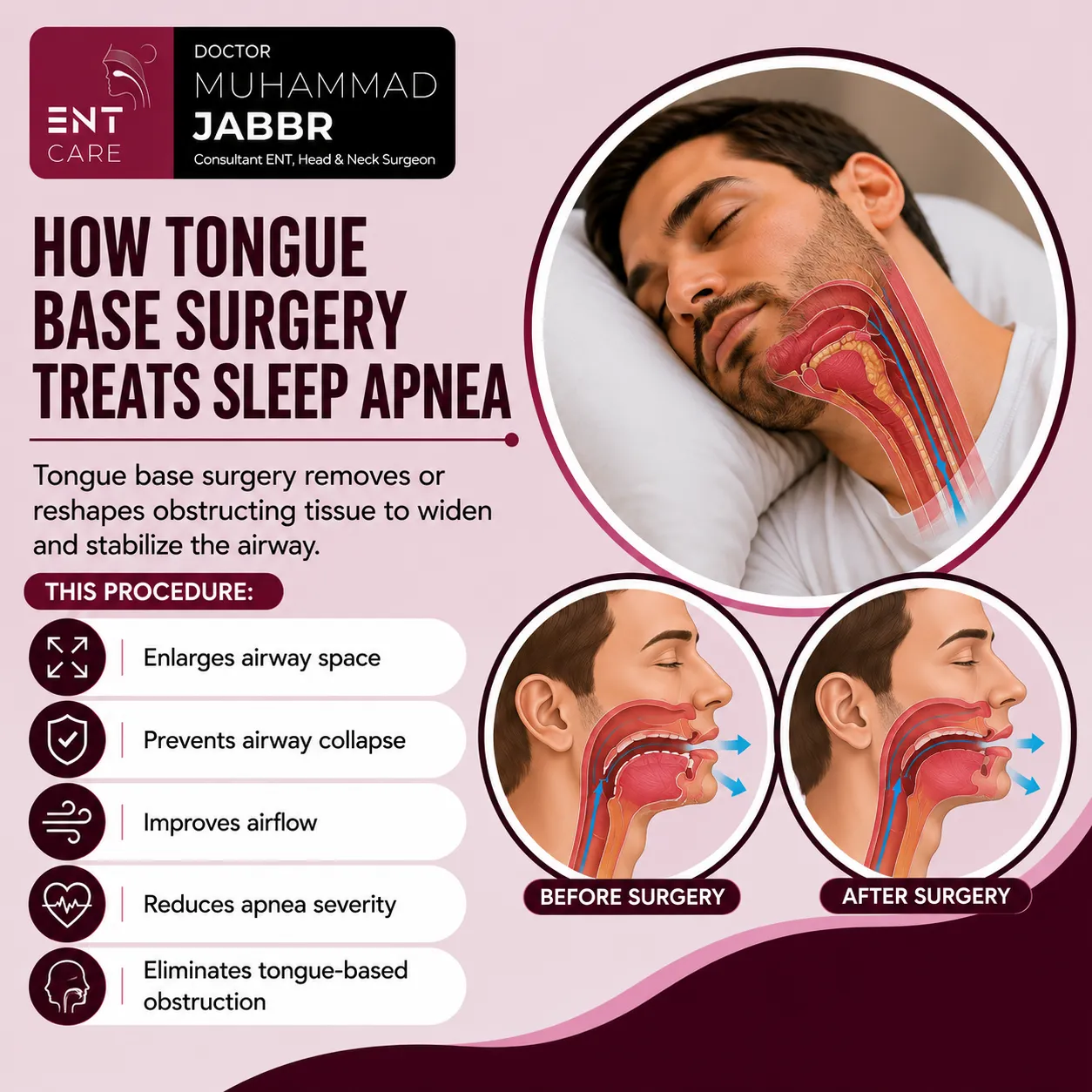 How Tongue Base Surgery Treats Sleep Apnea