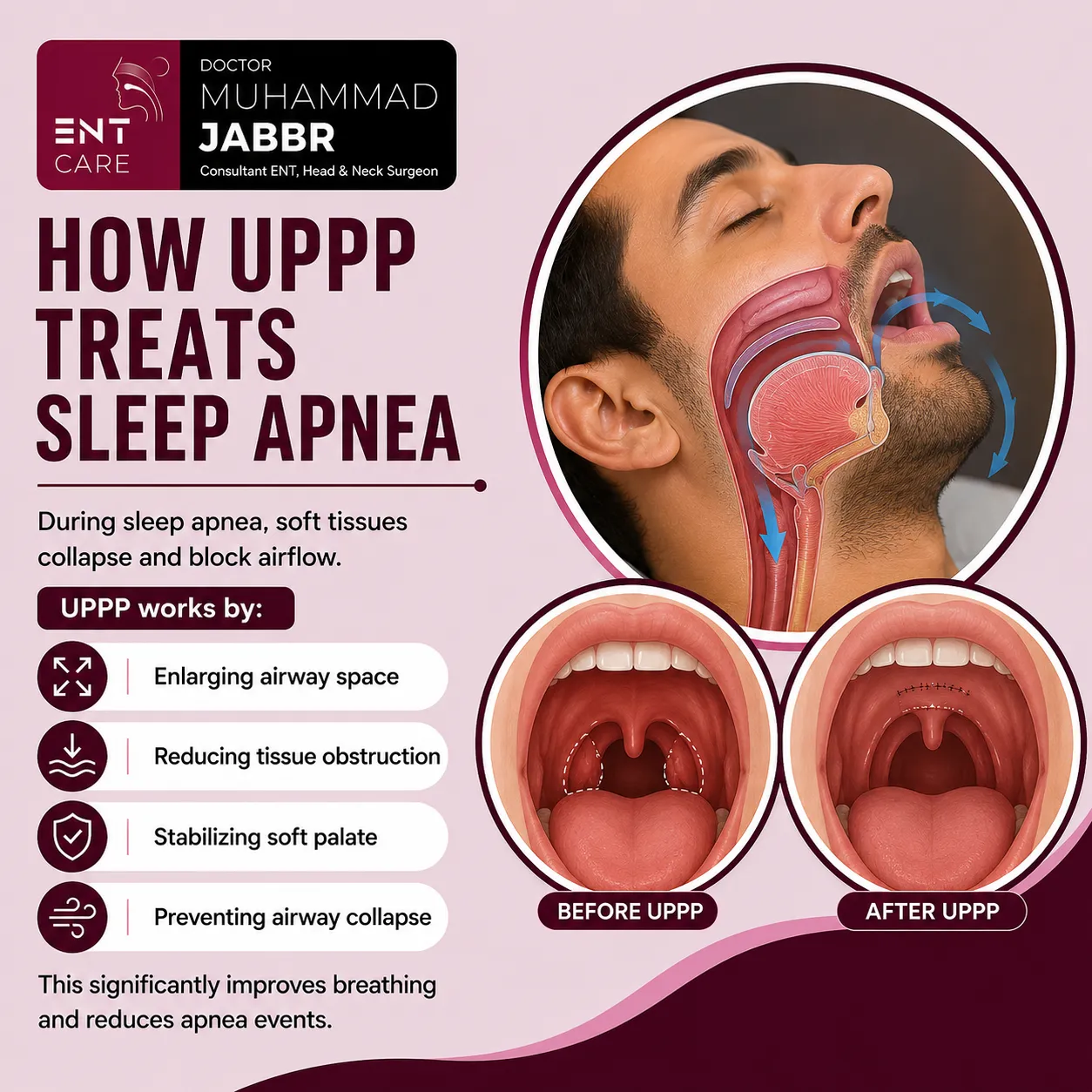 How UPPP Surgery Treats Sleep Apnea