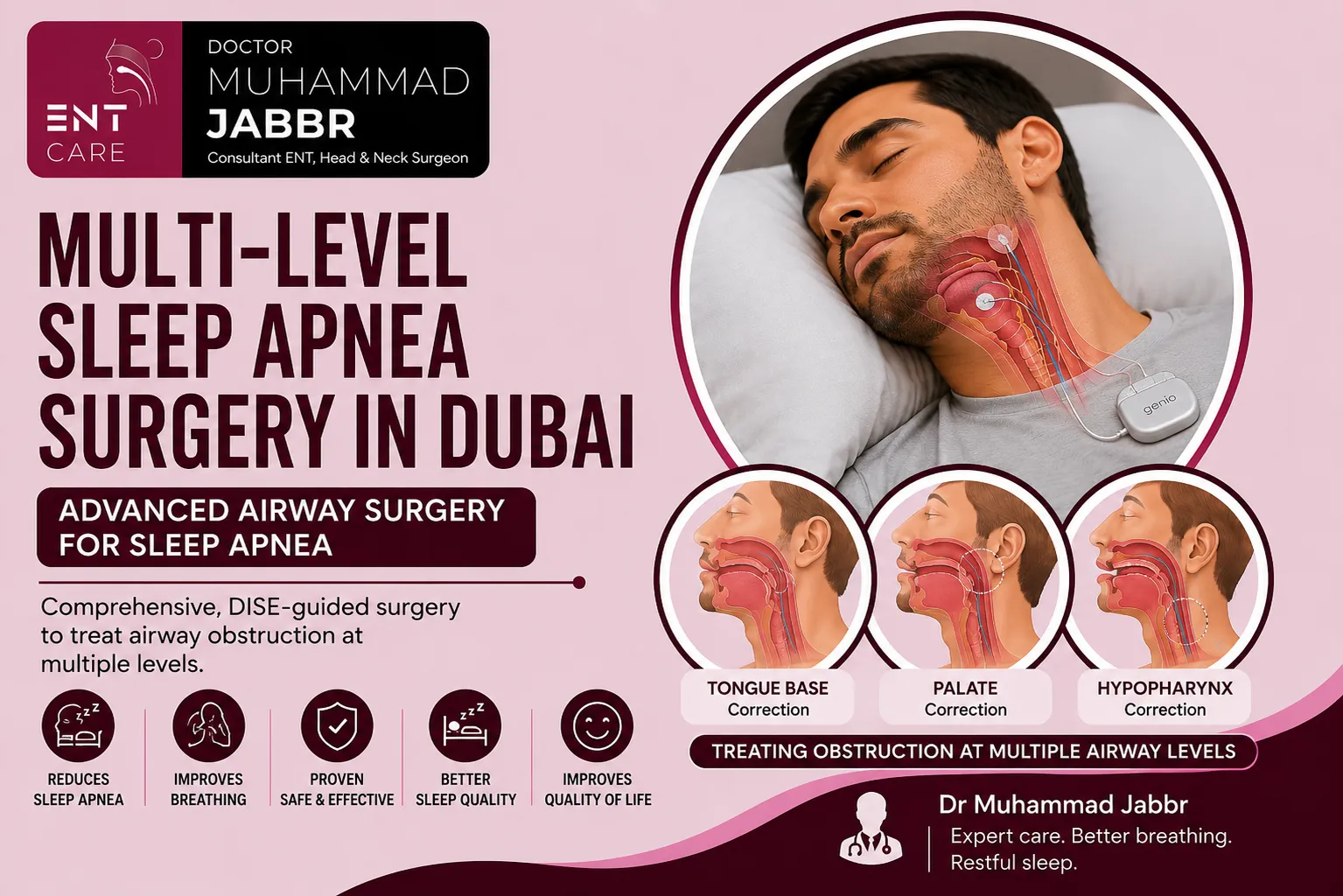 Multi-Level Sleep Apnea Surgery in Dubai by Dr Muhammad Jabbr
