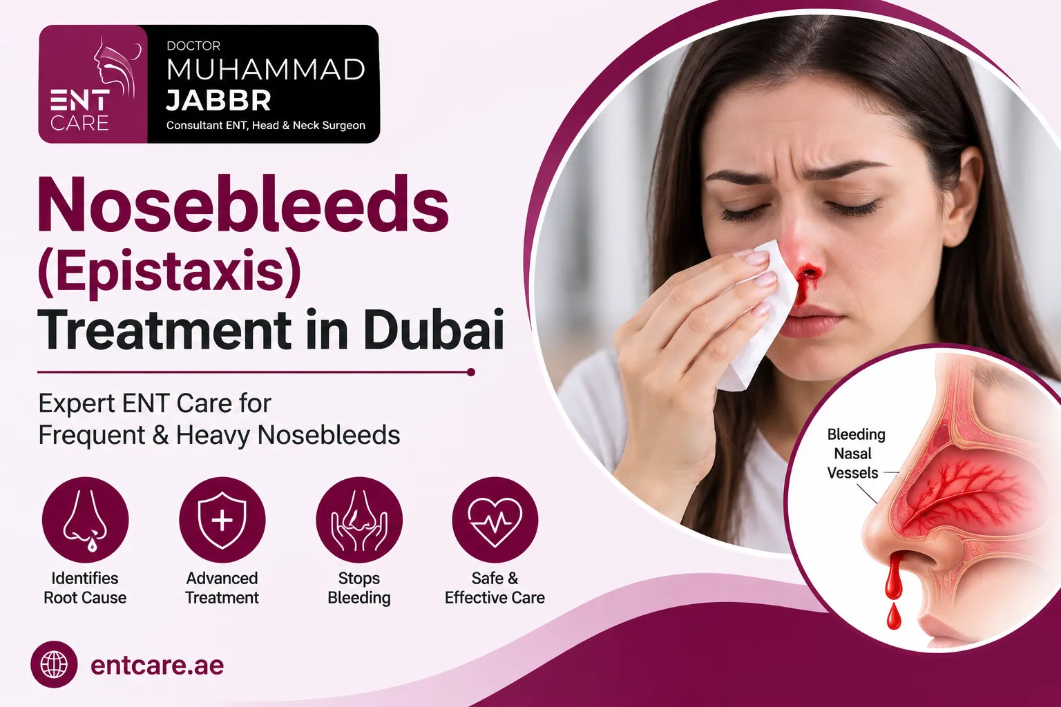 Nosebleeds (Epistaxis) Treatment in Dubai by Dr Muhammad Jabbr