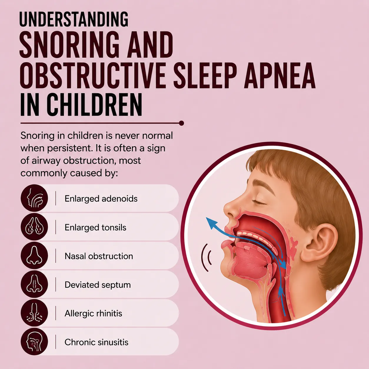 Snoring and Obstructive Sleep Apnea in Children