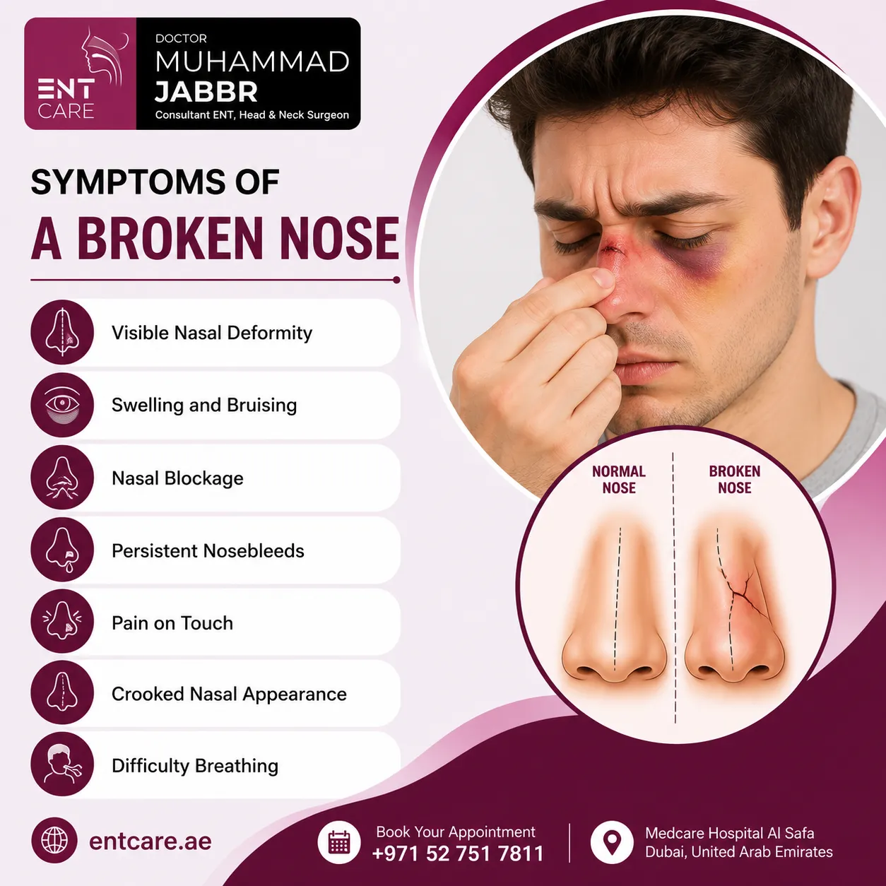 Symptoms of a broken nose in Dubai