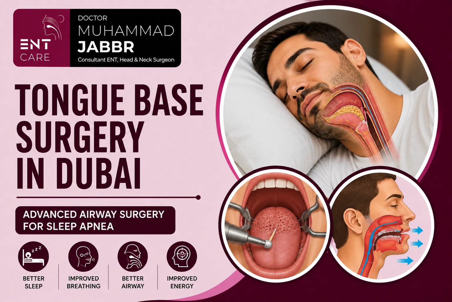 Tongue Base Surgery in Dubai by Dr Muhammad Jabbr