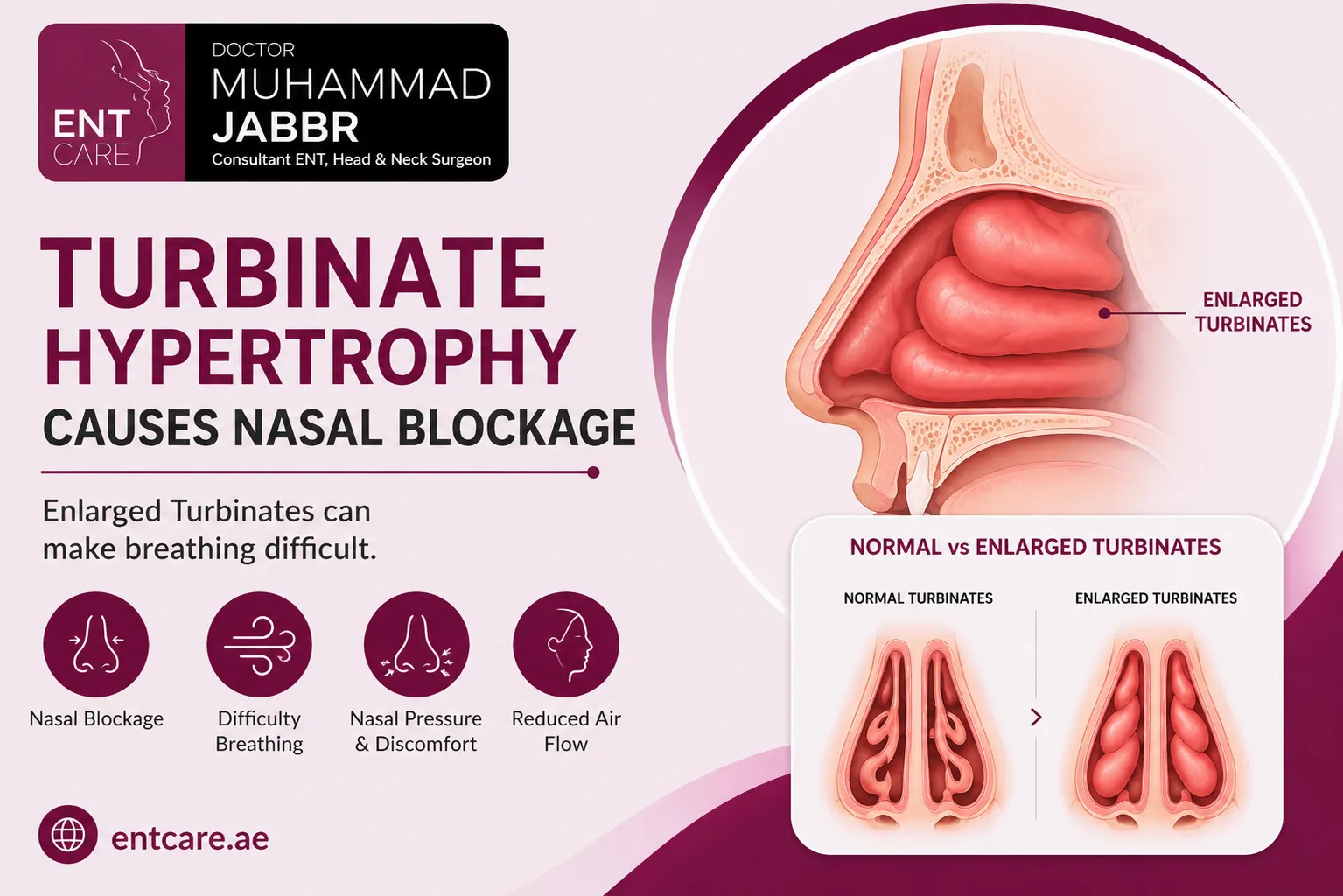 Turbinate Hypertrophy Treatment in Dubai by Dr Muhammad Jabbr