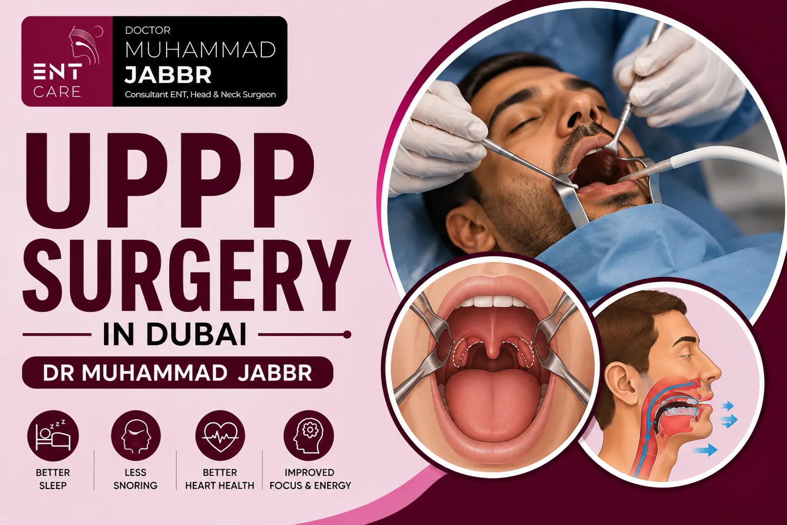 UPPP Surgery in Dubai by Dr Muhammad Jabbr