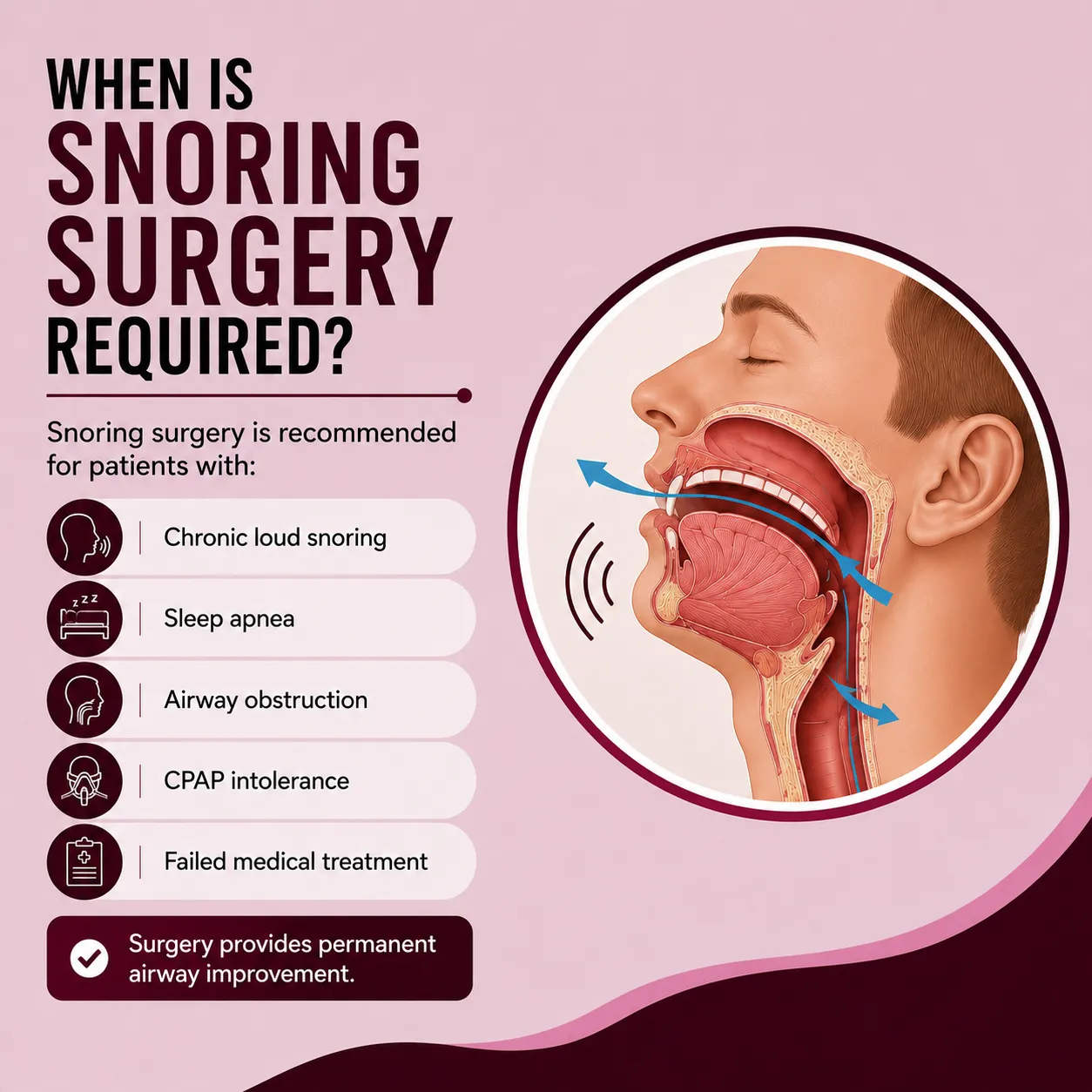 When is Snoring Surgery Required?